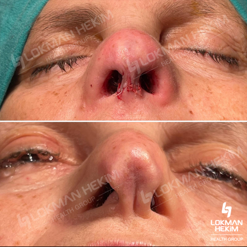 Rinoplastia (con injerto) Foto antes/después